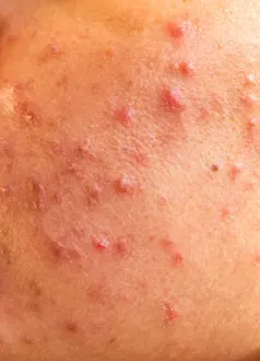 Acne / Pimples
