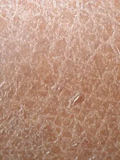 Dry Skin