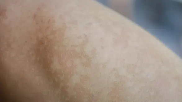 Uneven Skin